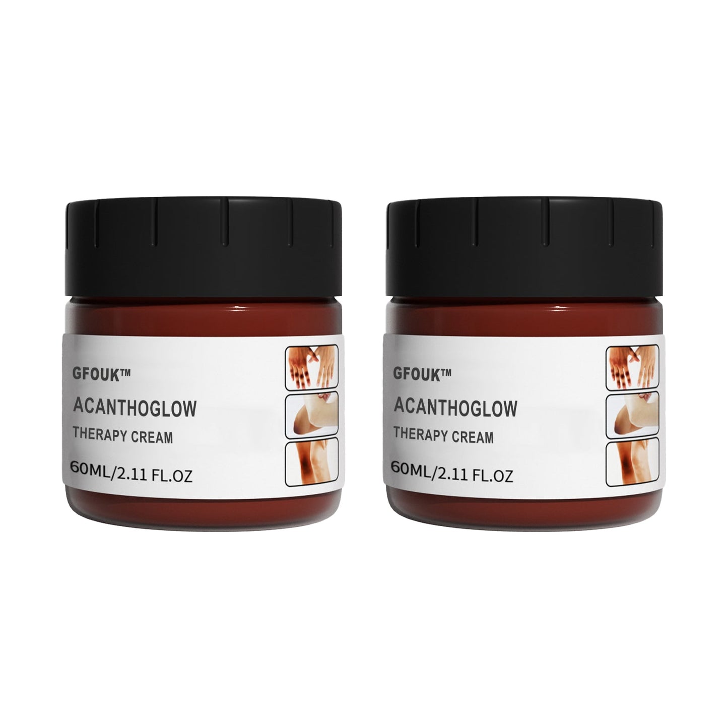 GFOUK™ AcanthoGlow Therapy Cream